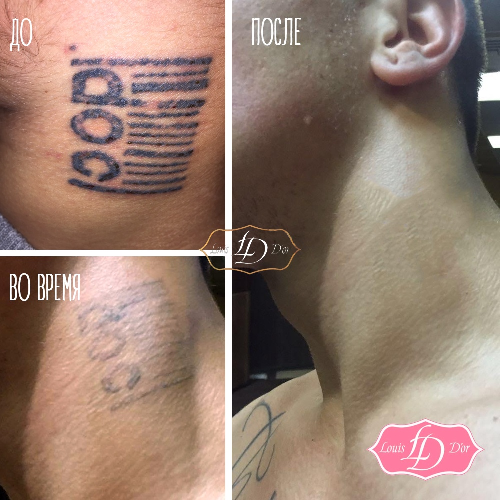 Удаление татуировки на шее неодимовым лазером