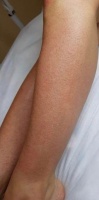 Анастасия - лазерная эпиляция голеней