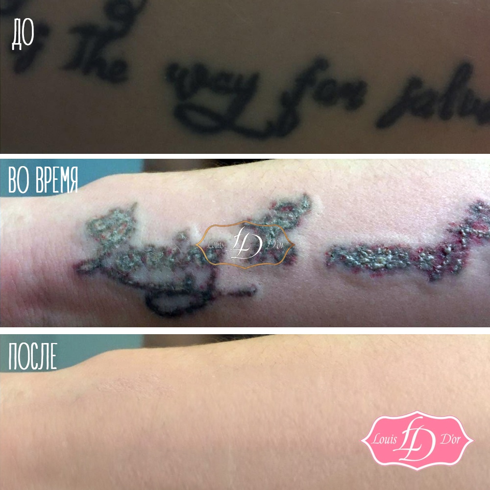 Лазерное удаление тату | VK