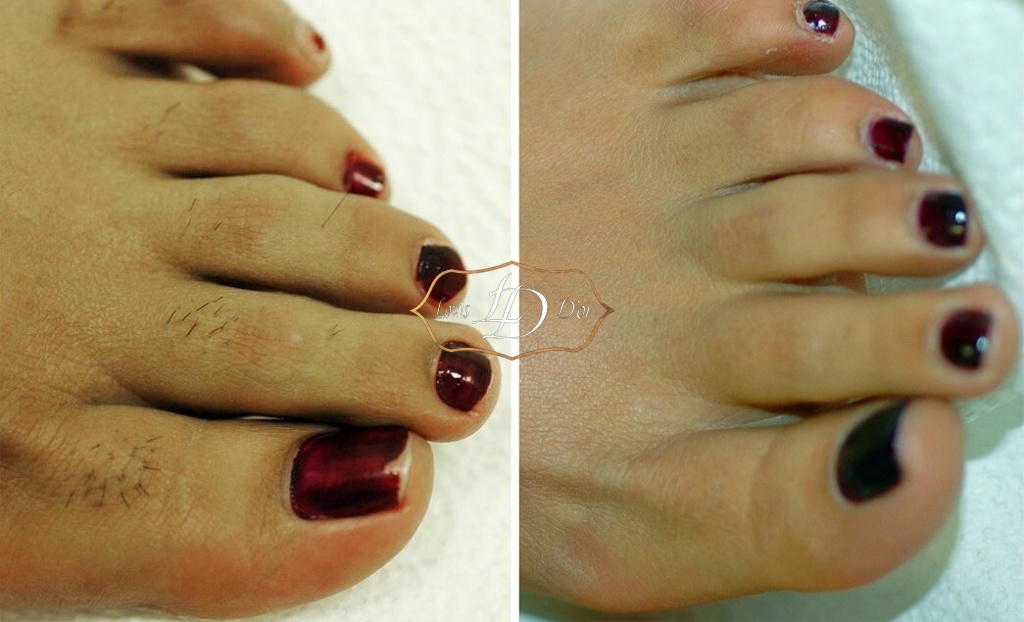 До и после лазерной эпиляции пальцев ног