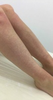 Мария - лазерная эпиляция ног в Чертаново